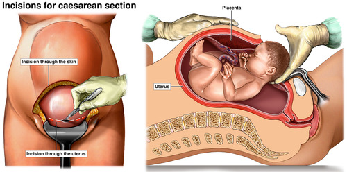 Cesarean Delivery