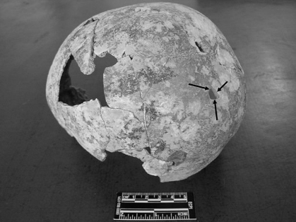 Acemhöyük trephination from the lateral view