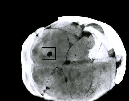 Radiograph of Acemhöyük skull from the basal view. Trephination hole lies on the lambdoid