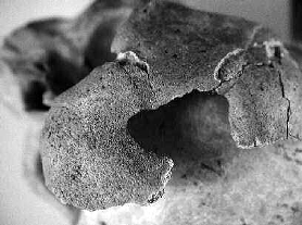 Trephination case from Assos. Note the borders of the opening are beveled and cicatrized, indicating healing